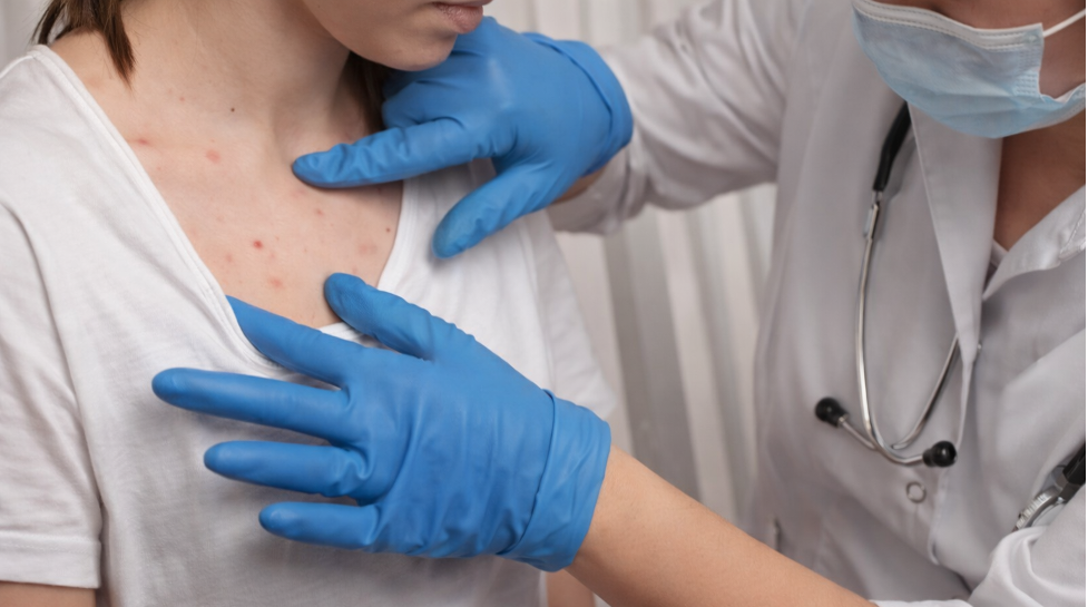 El sarampión no es cosa del pasado